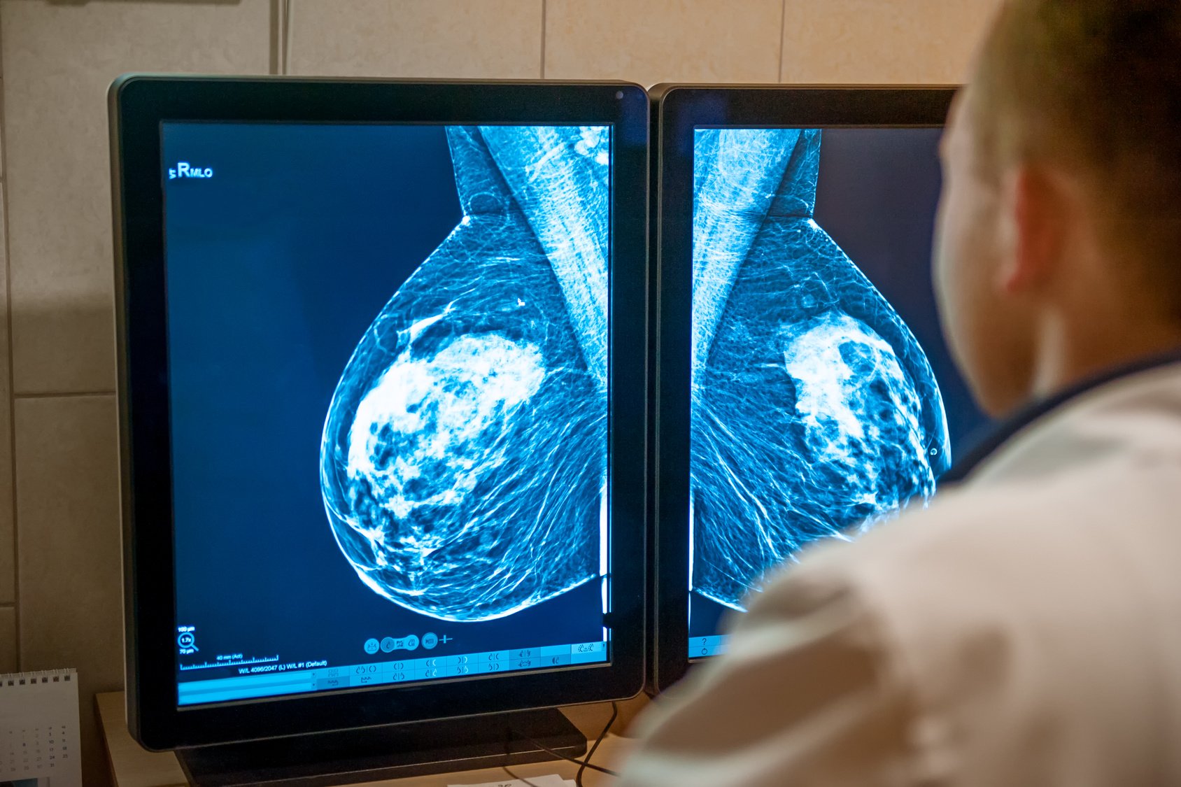The Benefits Of Mammography In Early Breast Cancer Diagnosis