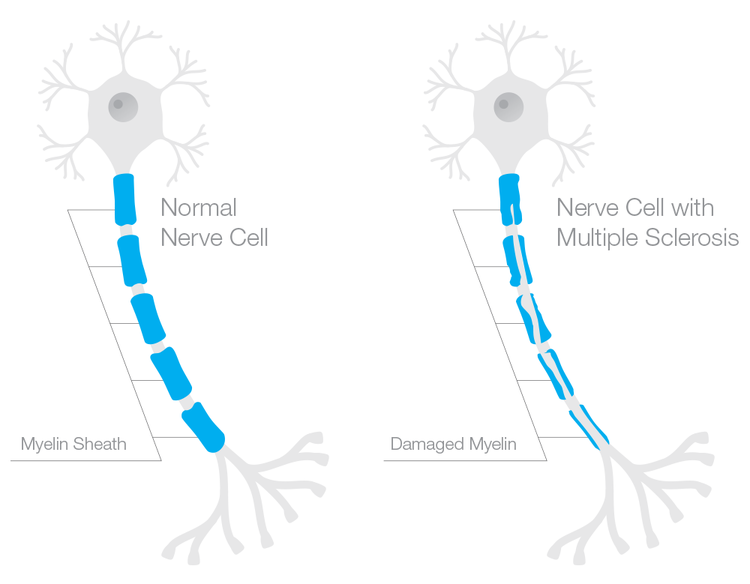 new multiple sclerosis treatments myelin