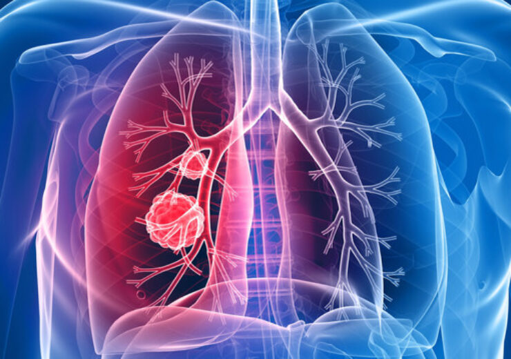 Chest-Lung-Cancer
