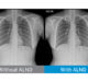 Samsung gets FDA approval for AI tool to detect lung nodules in chest X-rays