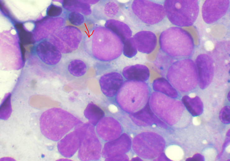 Novartis gets FDA approval for Scemblix to treat chronic myeloid leukaemia