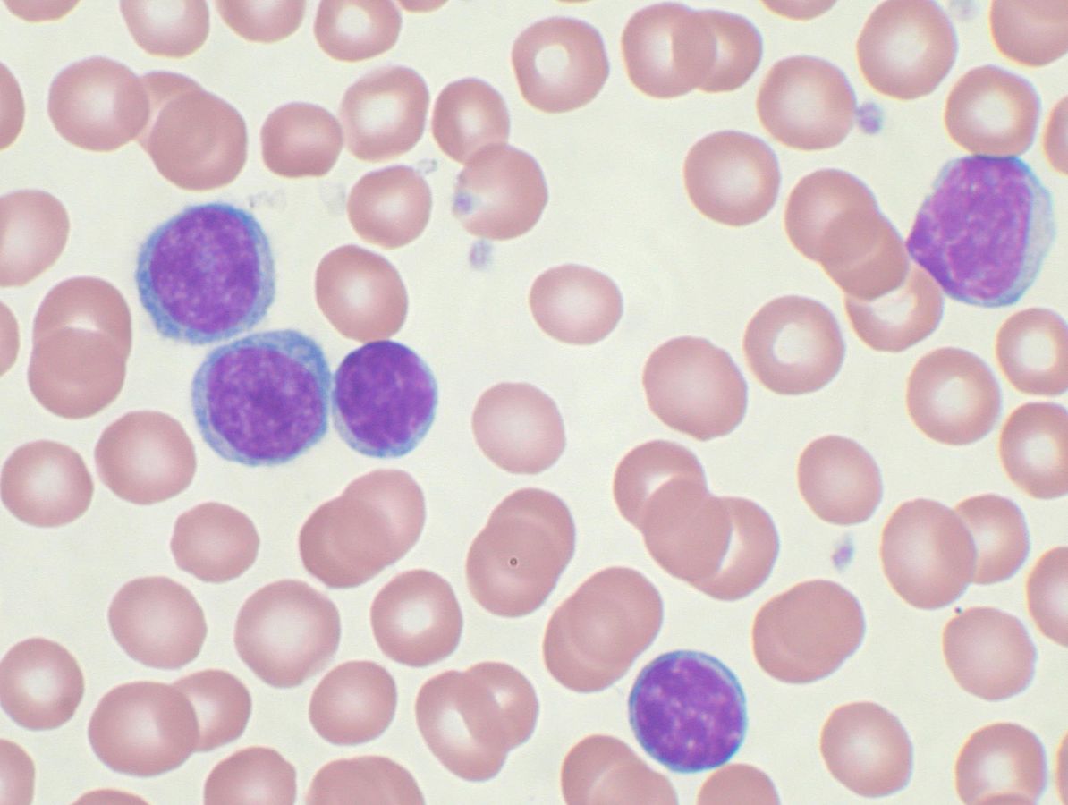 B-cell chronic lymphocytic leukaemia (B-CLL). (Credit: VashiDonsk/English Wikipedia.)