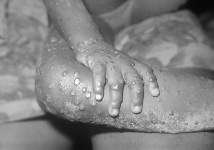 Massachusetts authorities confirm first case of monkeypox in US