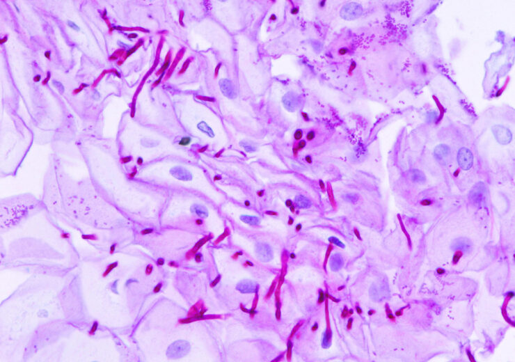 1194px-Esophageal_candidiasis_(2)_PAS_stain