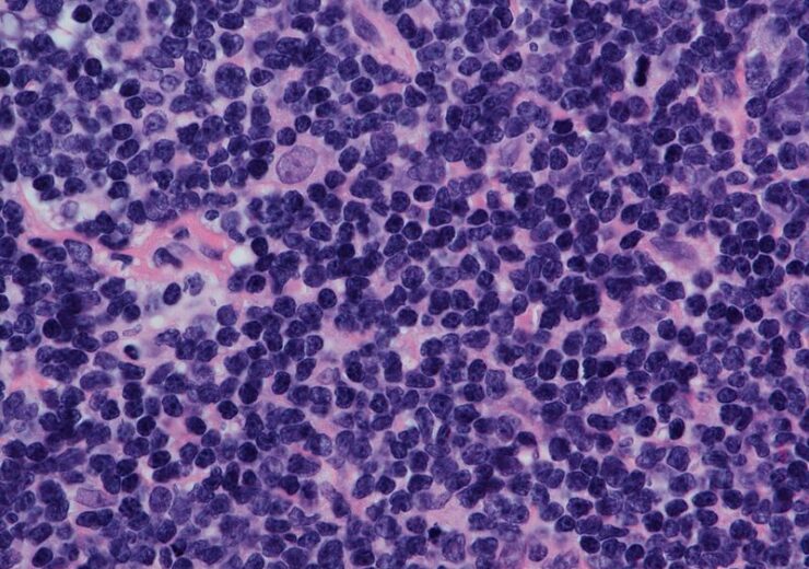 800px-Nodular_Mantle_Cell_Lymphoma_-_high_power_view_-_by_Gabriel_Caponetti