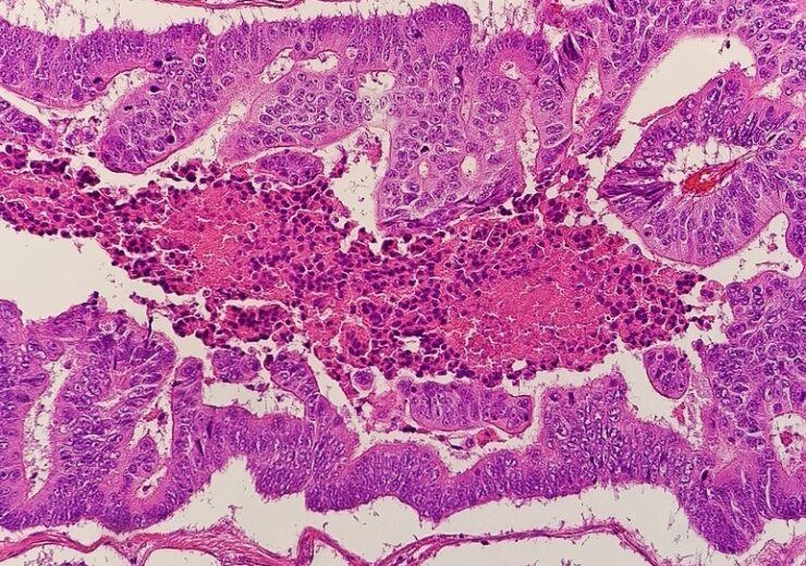 Micrograph_of_colorectal_carcinoma_with_dirty_necrosis
