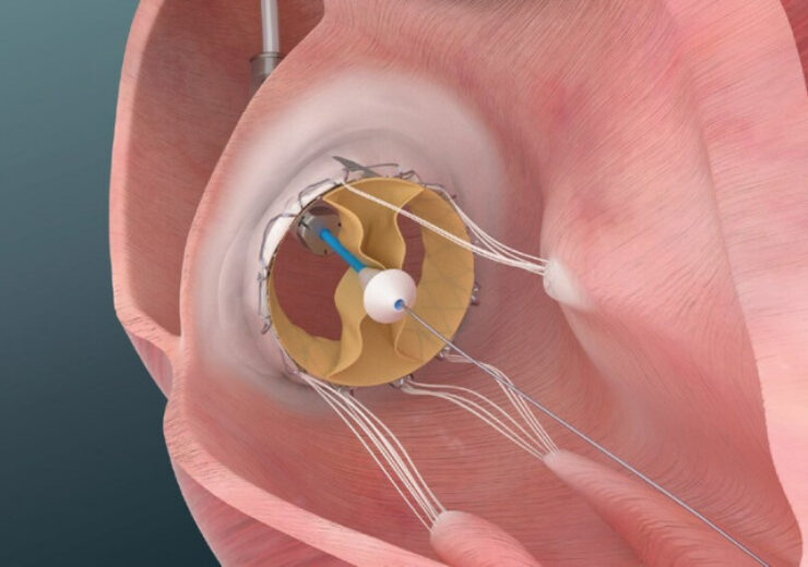 Trisol announces successful implants of its Transcatheter Tricuspid Valve in the US