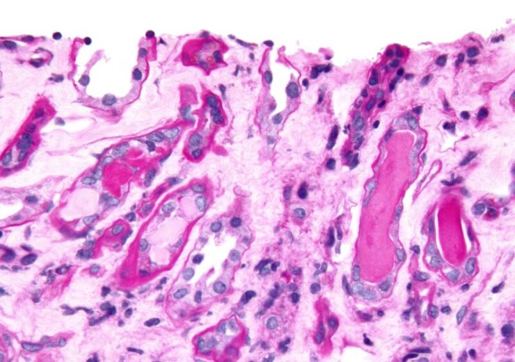 1200px-Cast_nephropathy_-_2_cropped_-_very_high_mag