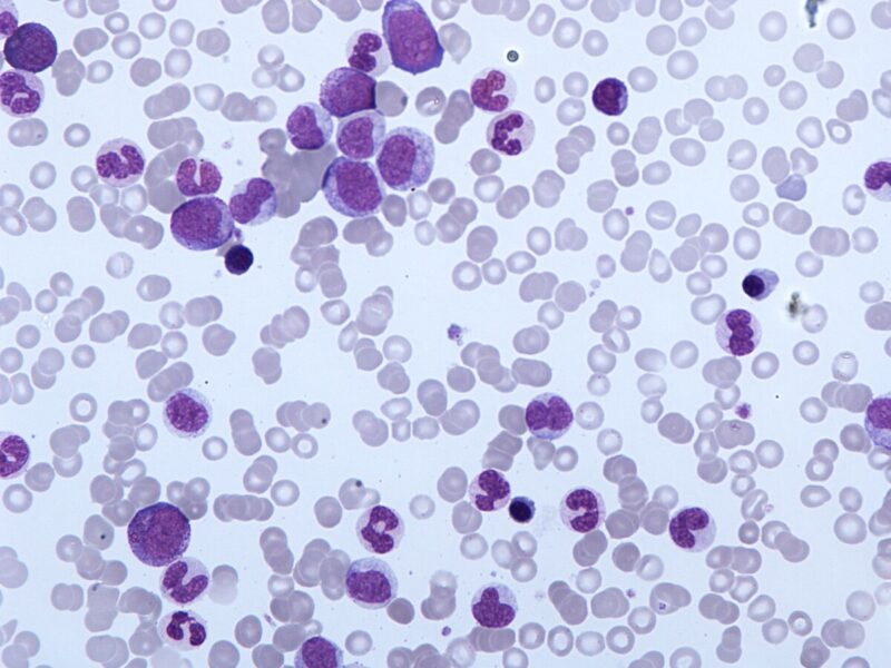 An image of CMML on peripheral blood film. (Credit: Simon Caulton from Wikimedia Commons)