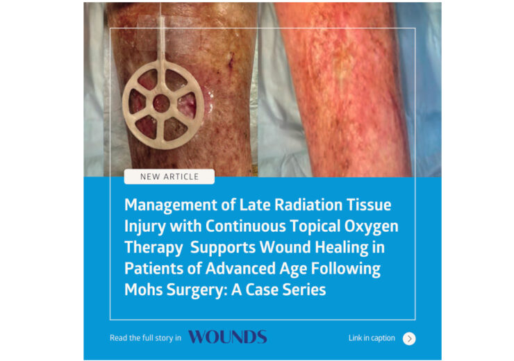 Accelerated healing with NATROX® O₂: Managing Late Radiation Tissue Injury Post-Mohs Surgery