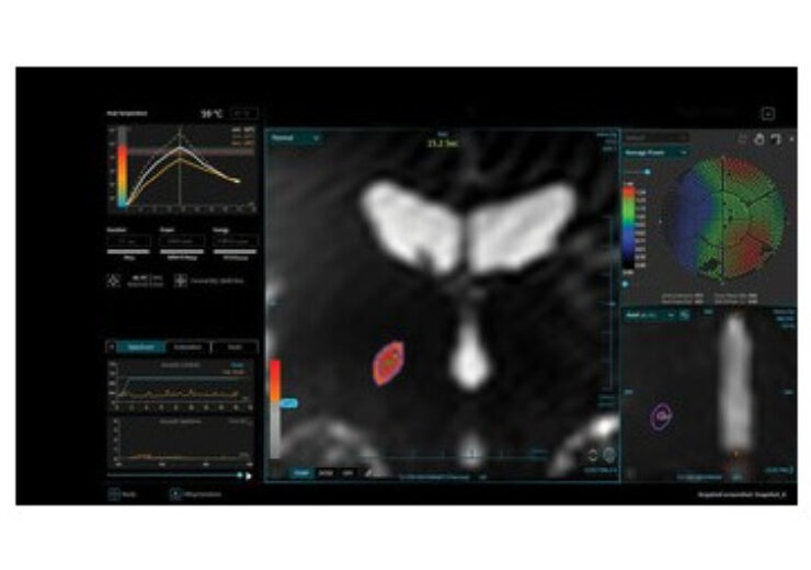 Insightec Announces Exablate Prime Availability In Europe -The next generation Of MR-guided focused ultrasound